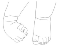 Positional talipes