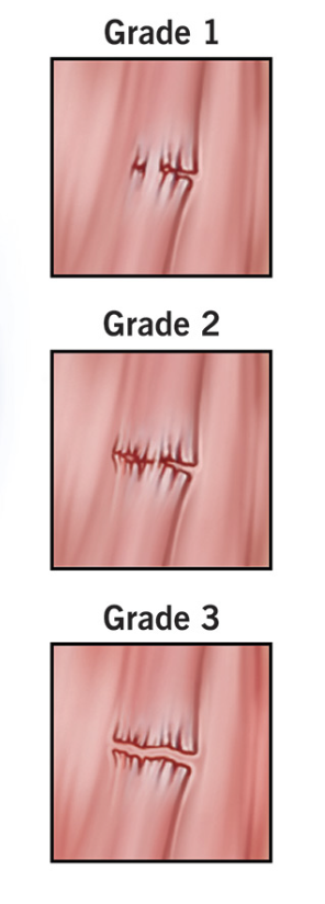 Hamstring injury classification