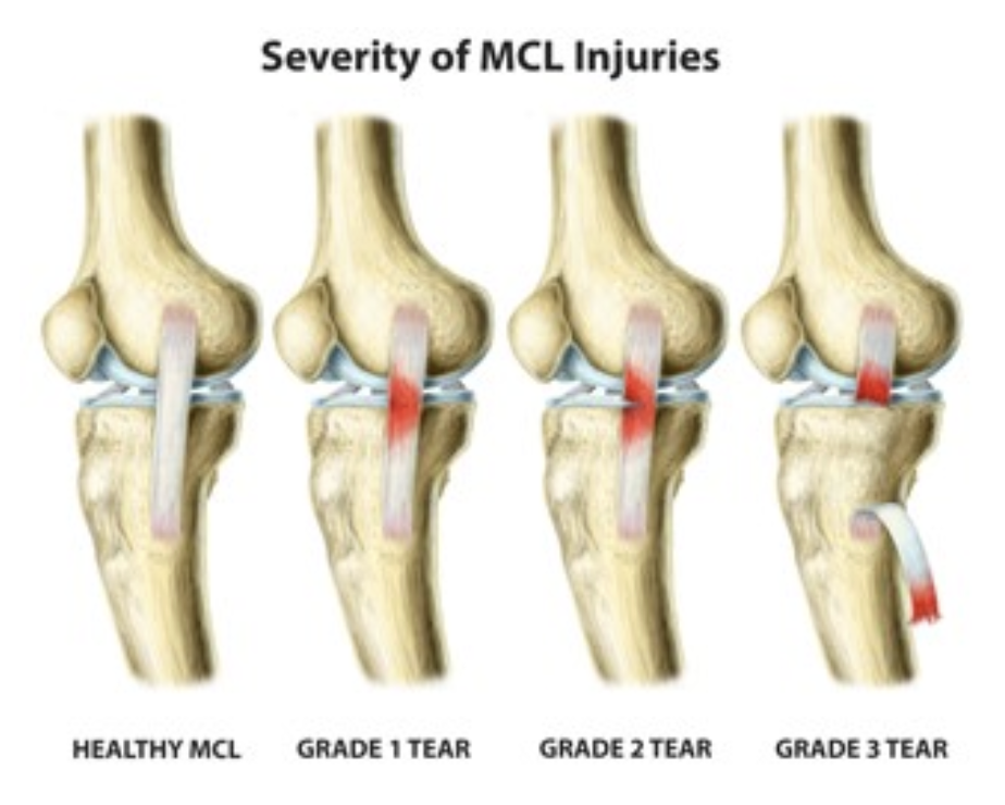 MCL Knee Injury
