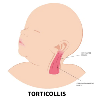 Torticollis in Babies